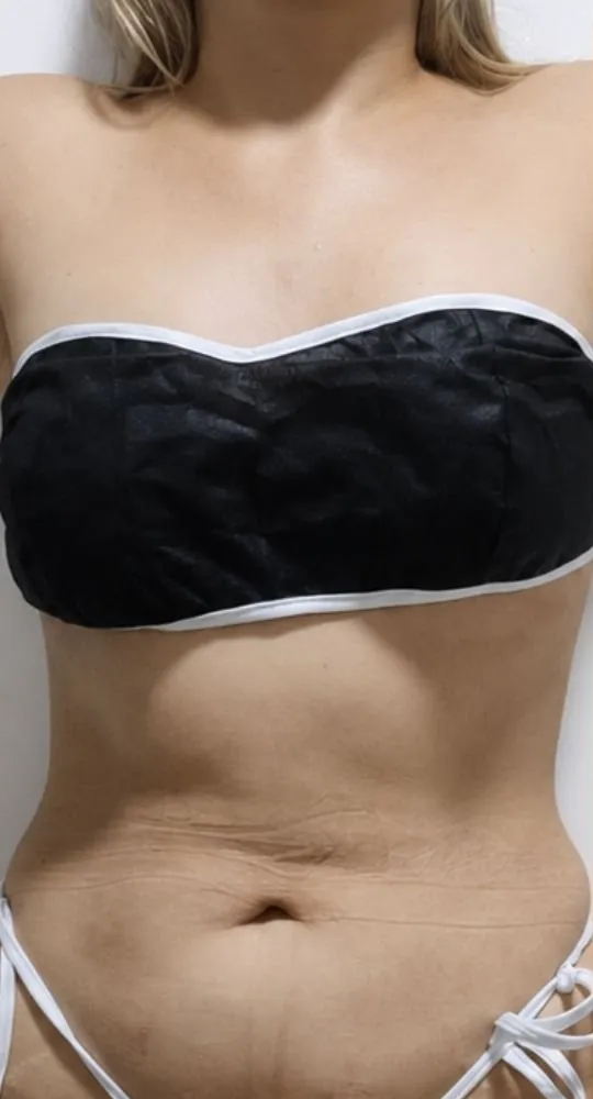 La misma paciente, abdomen de frente, en su primera visita
