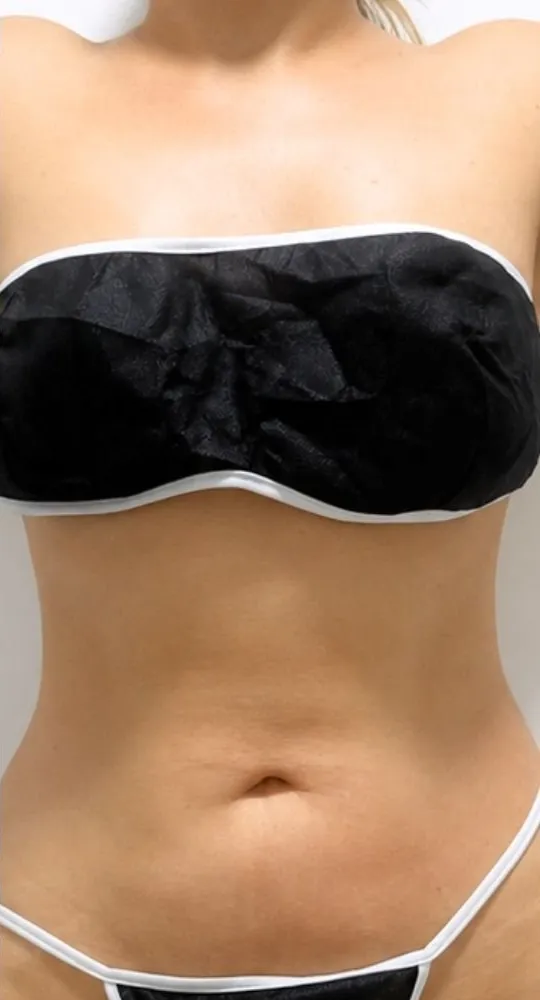 Paciente real de Vivante, abdomen de frente, en su control